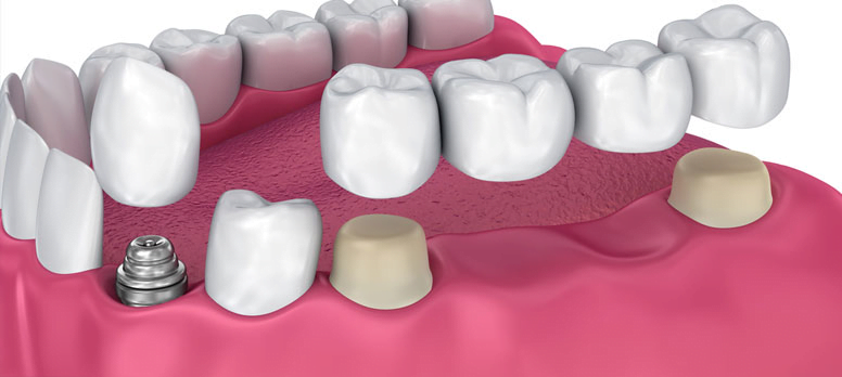 Kuron-Köprü Protezler